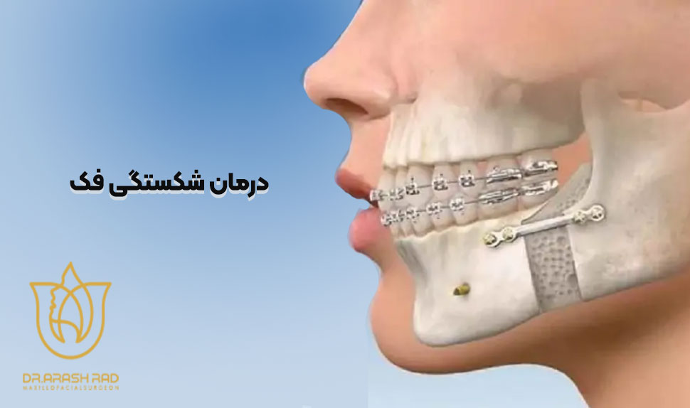 درمان شکستگی فک