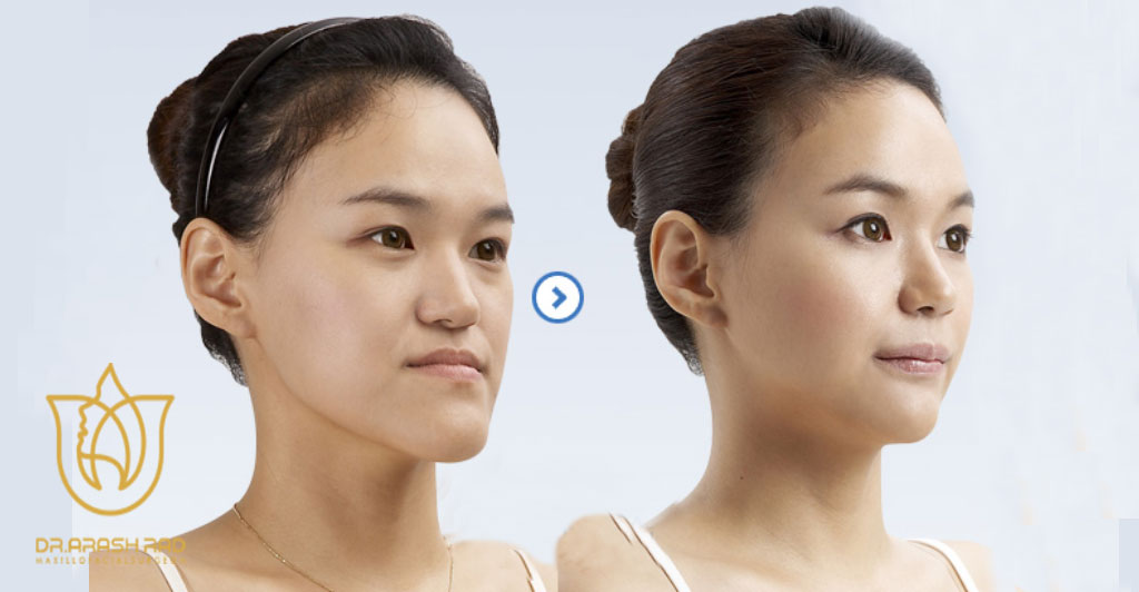 تغییر چهره بعد از جراحی فک و چانه