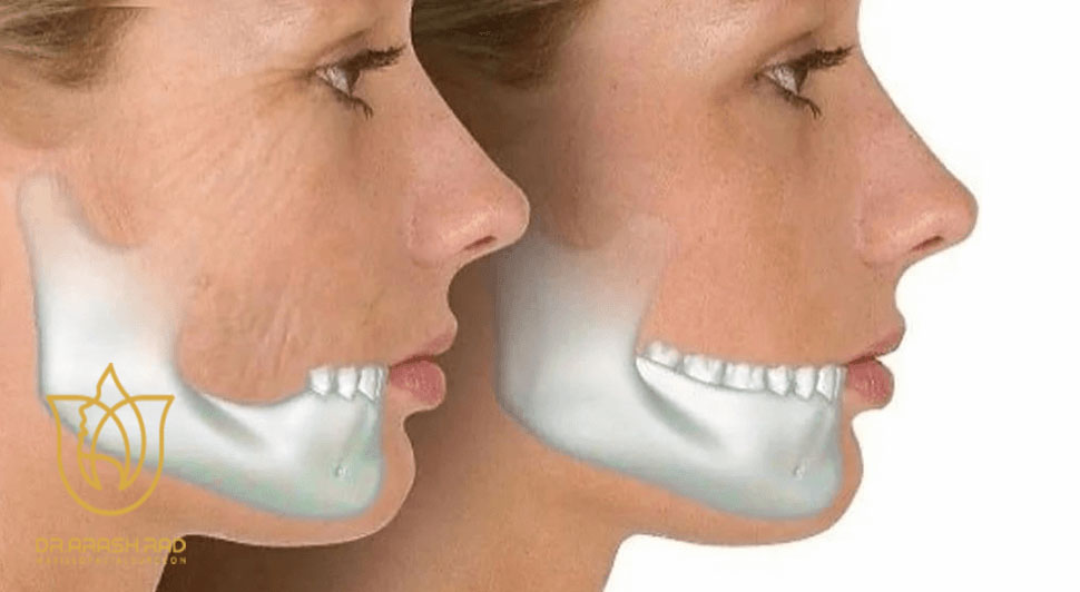 جراحی چانه چیست