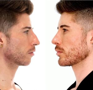 custom jawline implants Dubai