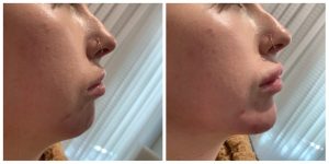 custom jawline implants Dubai