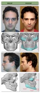 custom jawline implants Dubai