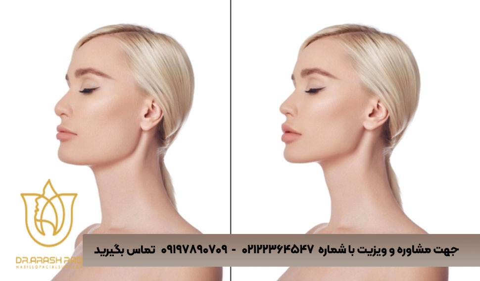 چرا زاویه‌سازی فک با دکتر مانی آرش‌راد 