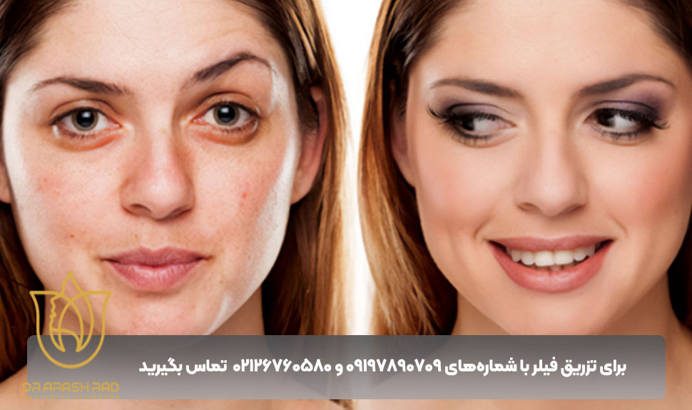 تخصص دکتر مانی آرشراد در تزریق فیلر