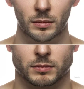 jaw contouring for men Dubai