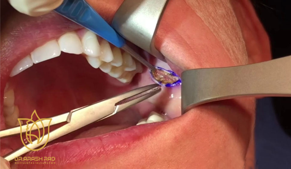 مراحل انجام جراحی بوکال فت