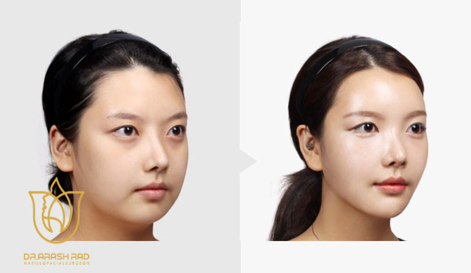 کاندیدای جراحی بوکال فت