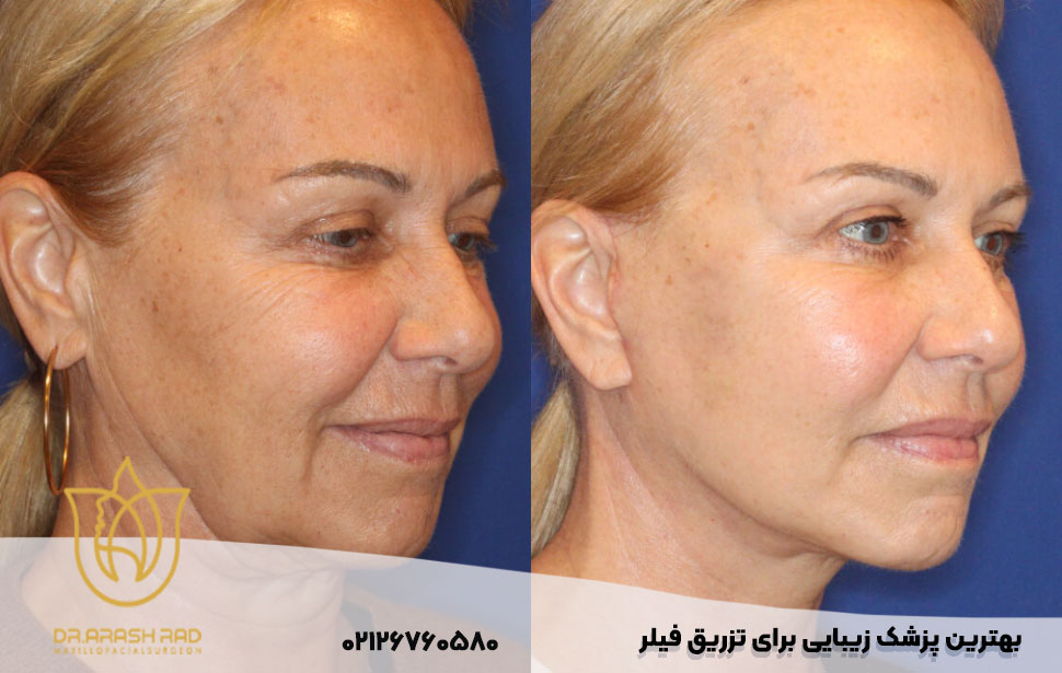 هزینه تزریق فیلر