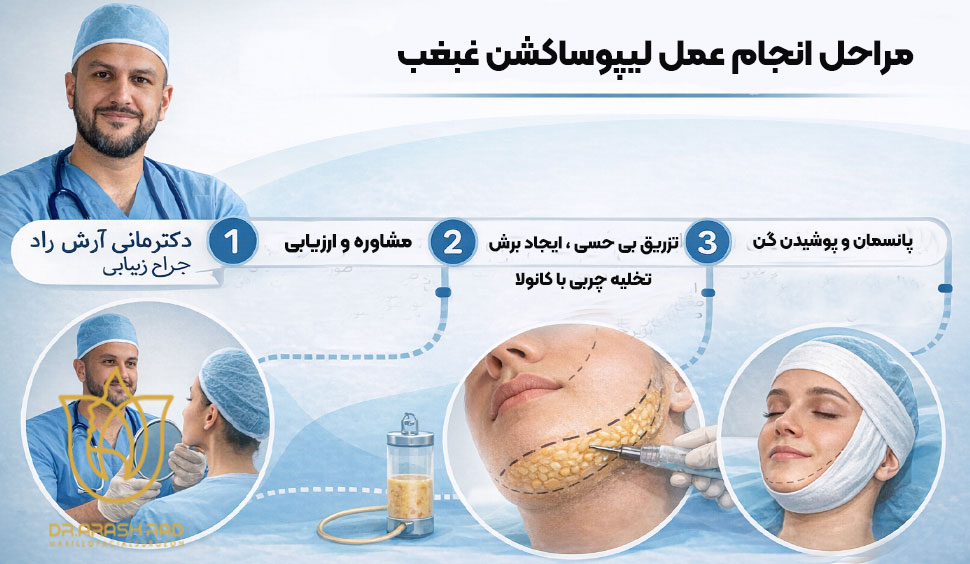 مراحل انجام لیپوساکشن غبغب