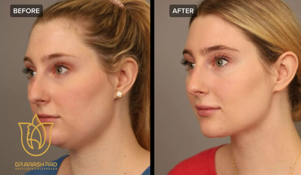 ماندگاری نتایج لیپوساکشن غبغب