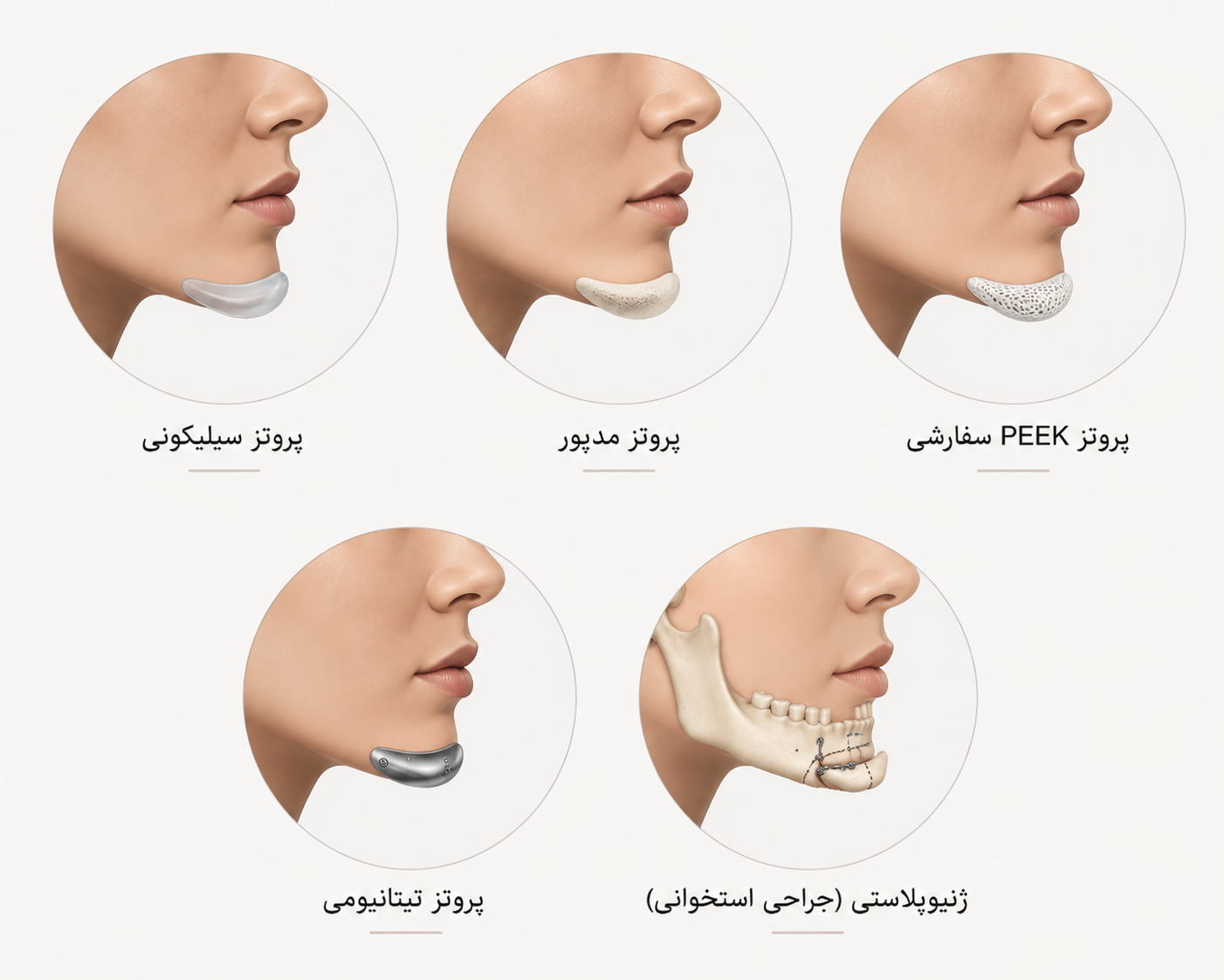 هزینه جراحی چانه