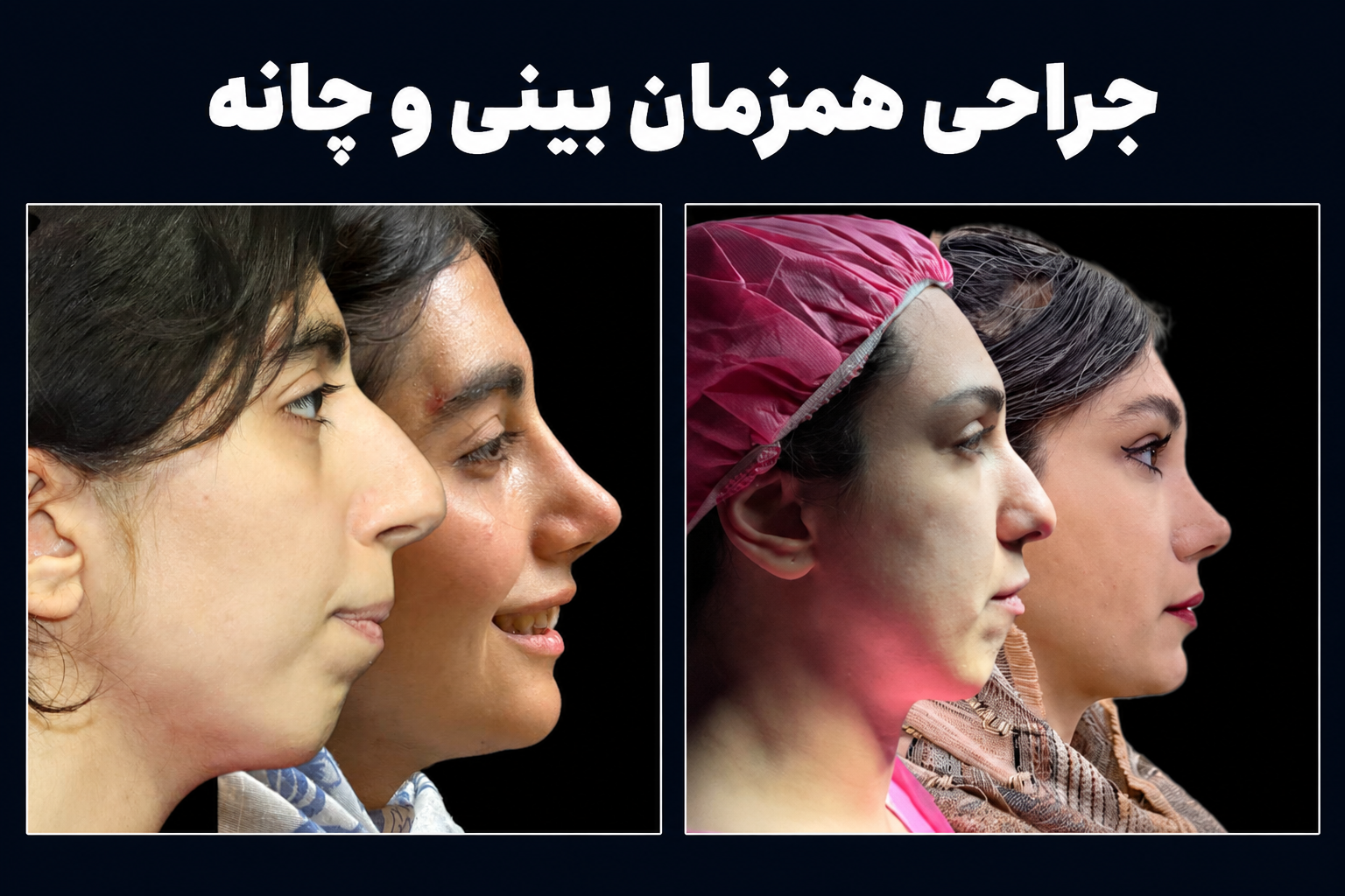 جراحی همزمان بینی و چانه