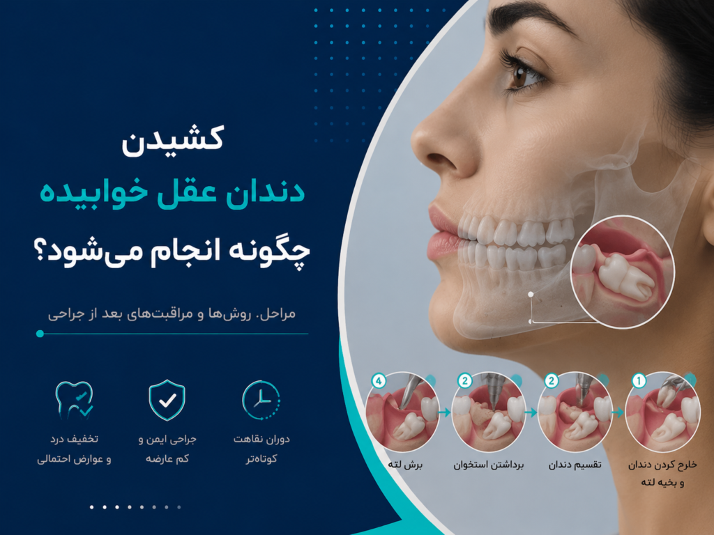 کشیدن دندان عقل خوابیده چگونه انجام می‌شود؟