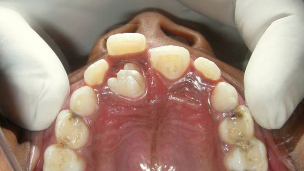 دندان اضافه چه خطراتی دارد؟ علائمی که نباید نادیده بگیرید